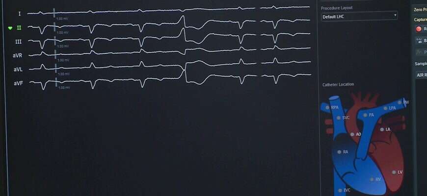 Больница сердце инфаркт кардиограмма