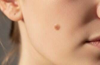 пятно на коже