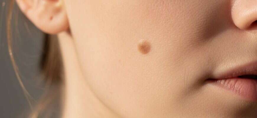 пятно на коже